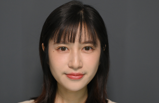 療程後｜AI美光針｜菲菲